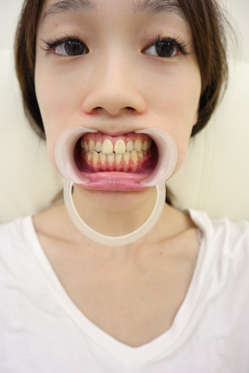 新莊艾旎牙醫Dr. Min 牙齒美白體驗